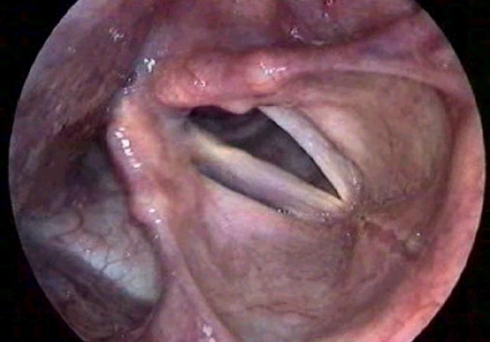 柯萨奇病毒急性喉炎图片