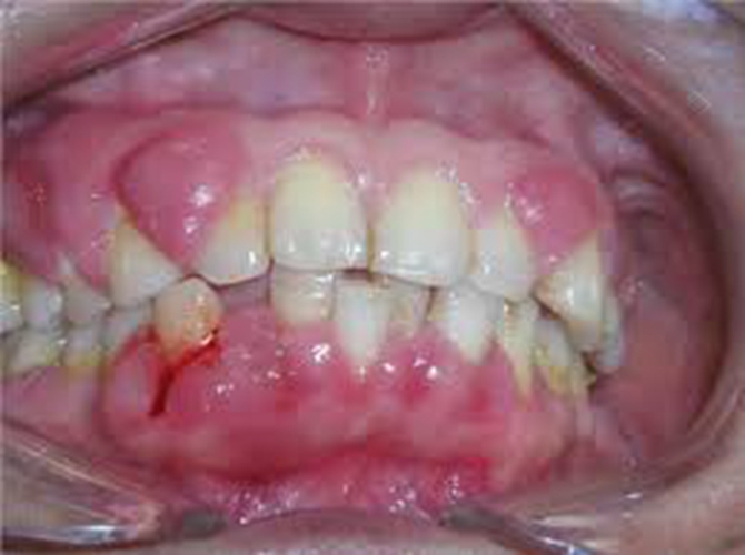 根尖牙周炎症状图片图片