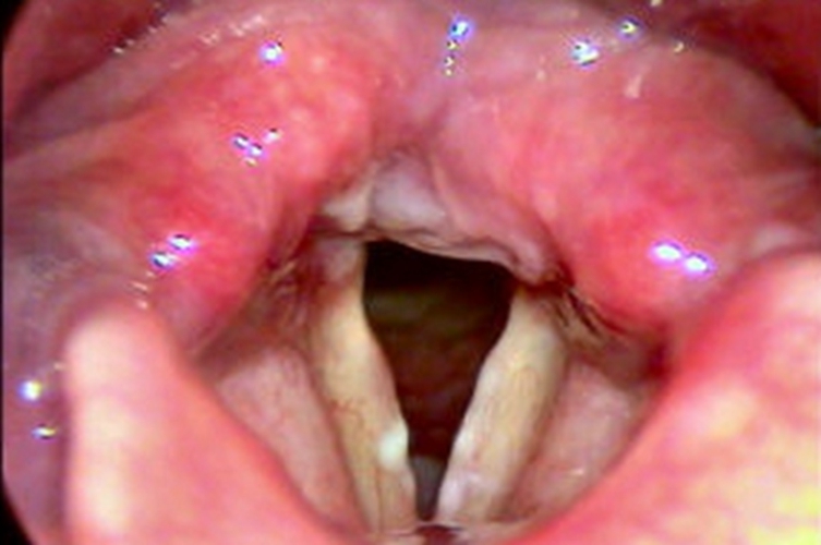 急性咽炎的末期的症状图片