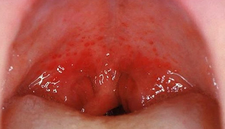 喉炎的症状及治疗方法图片