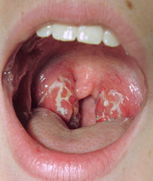 急性咽炎真实图片图片