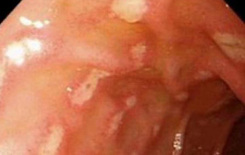 急性糜烂性胃炎的充血症状图片
