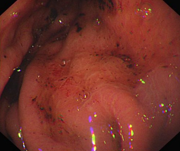 急性糜烂性胃炎的充血的症状图片