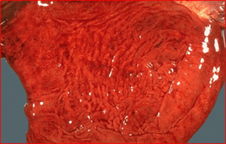 急性胃炎标本图片