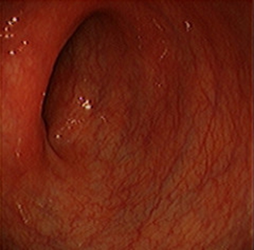 急性胃炎的阳性表现的图片