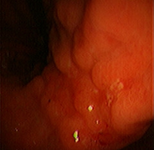 急性胃炎的阳性的表现图片