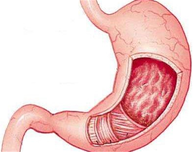 急性胃炎胃部图片