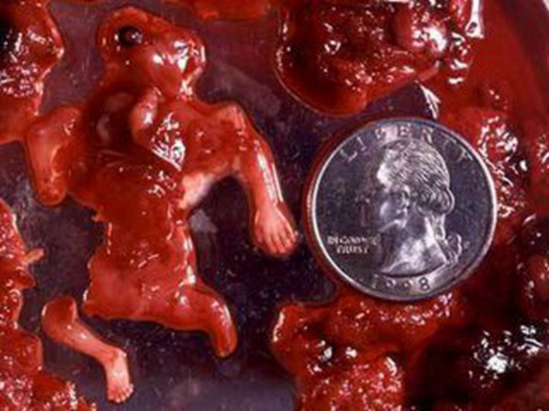 稽留流产胚胎图片图片