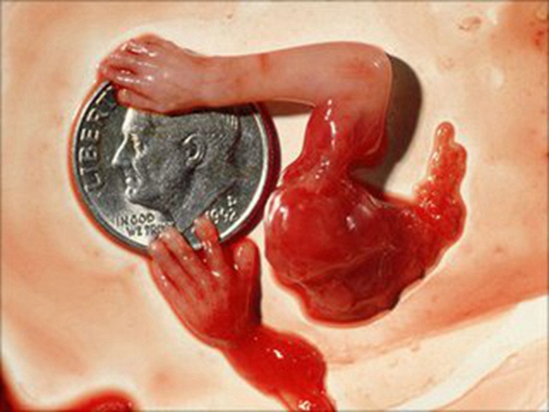 一个月内怎么堕胎图片图片
