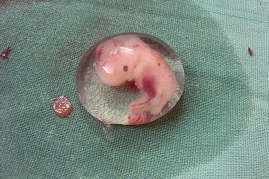 流产后图片 胚胎图片