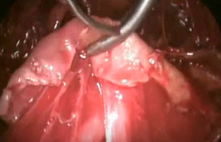 结核性胸膜炎的红色积液图片