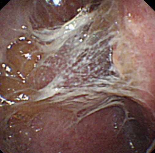 结核性胸膜炎的早期症状的图片