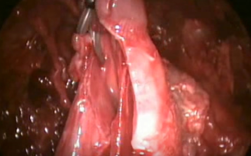 结核性胸膜炎红色的积液图片