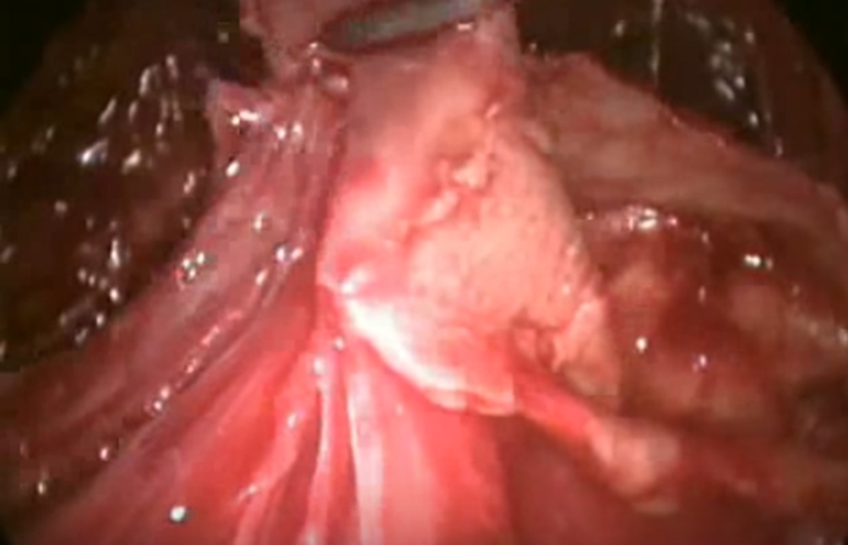 结核性胸膜炎红色积液图片