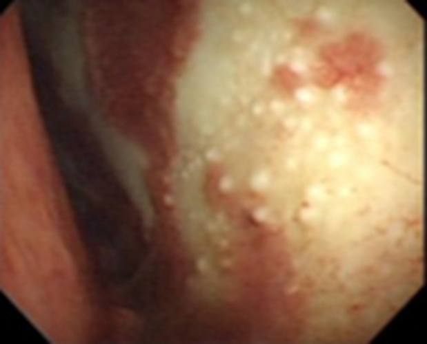结核性胸膜炎早期症状的图片