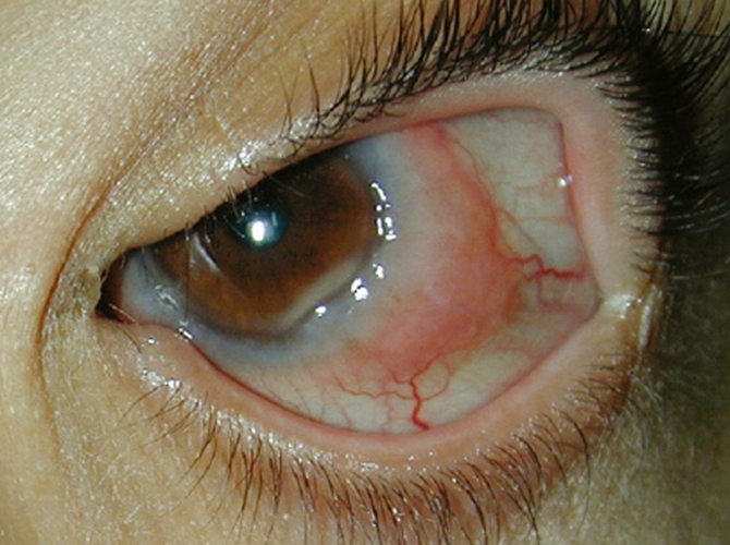 结膜炎初期症状图片