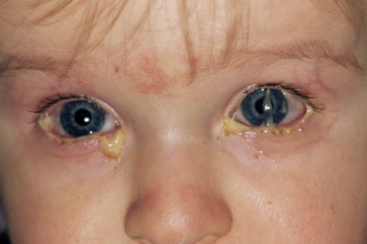 儿童结膜炎症状图片图片
