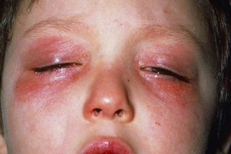 结膜炎图片初期 儿童图片