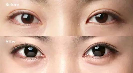 卧蚕填充的危害