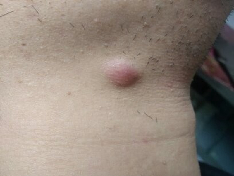 颈部淋巴癌早期图片图片
