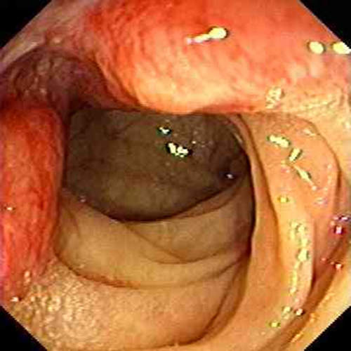  升结肠癌的肠镜的图片