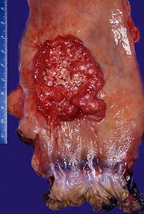 结肠良性肿瘤图片