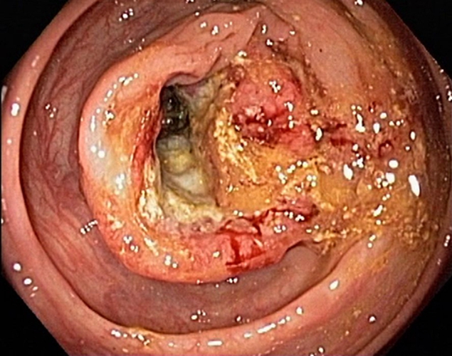 肠癌中期图片