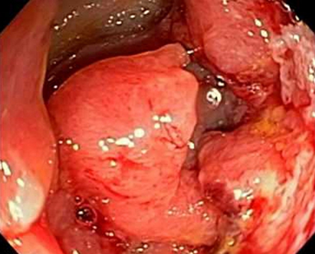 晚期的结肠癌腺癌症状图片