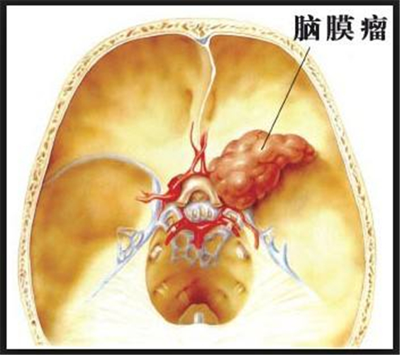 脑膜瘤图片 (2)