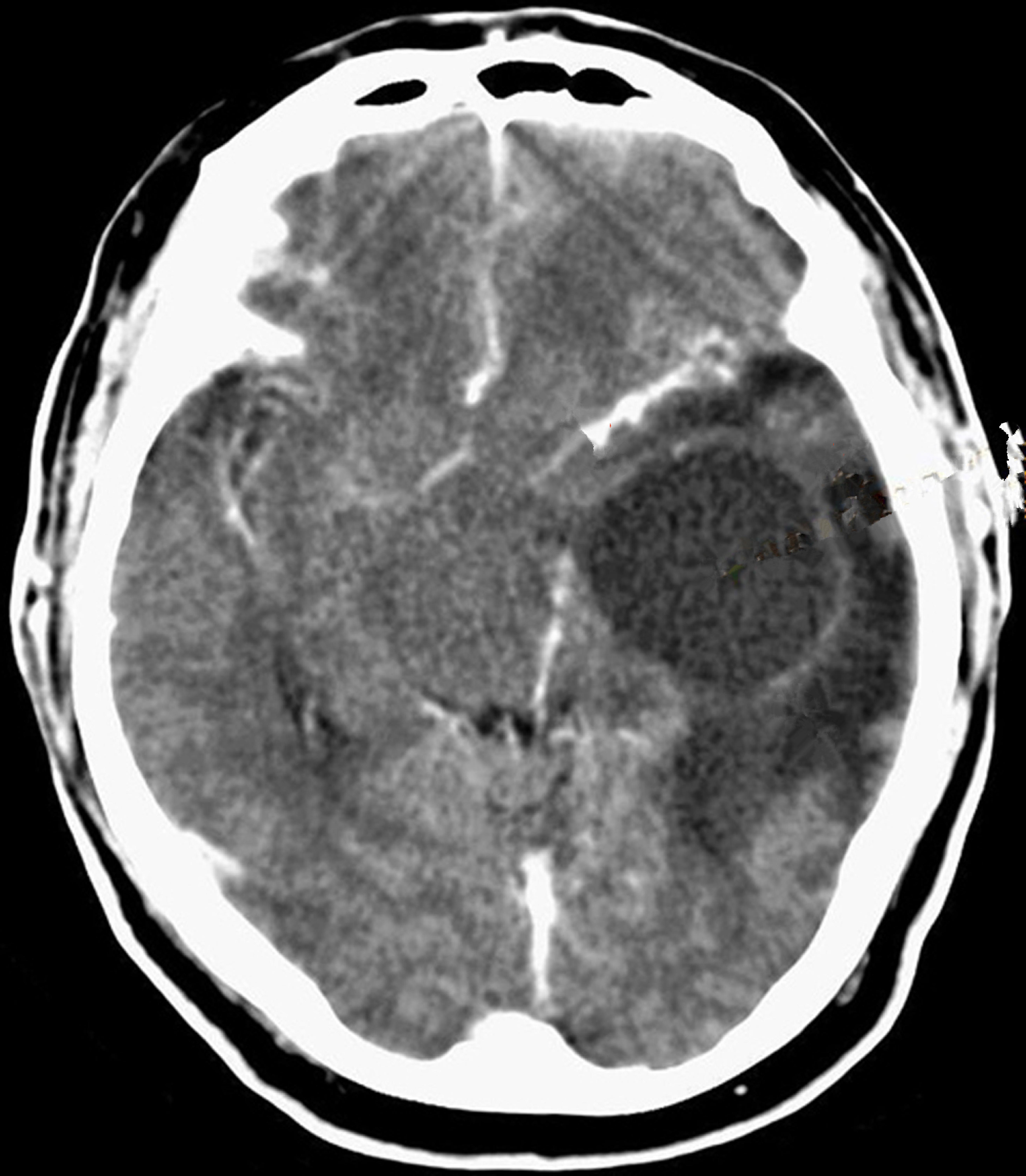 脑膜瘤的ct表现图片