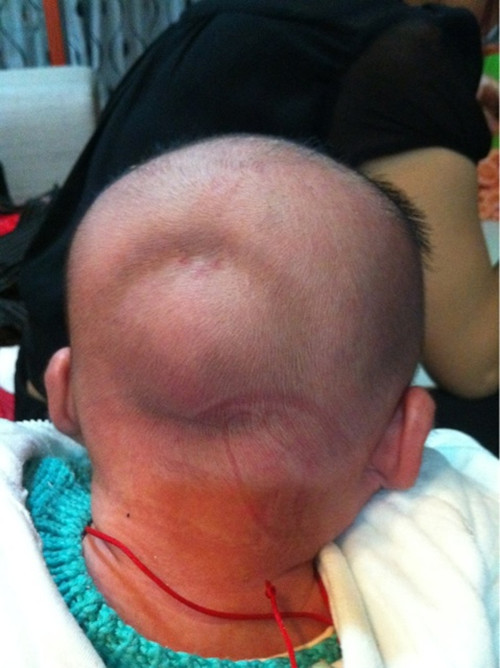 婴儿头上有血肿的图片图片