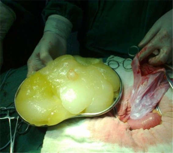 巨大卵巢囊肿里面是什么图片