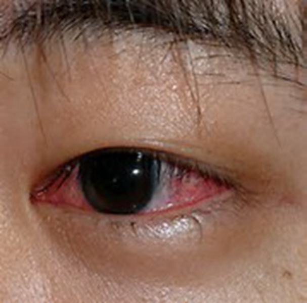 眼睛梅毒症状图片