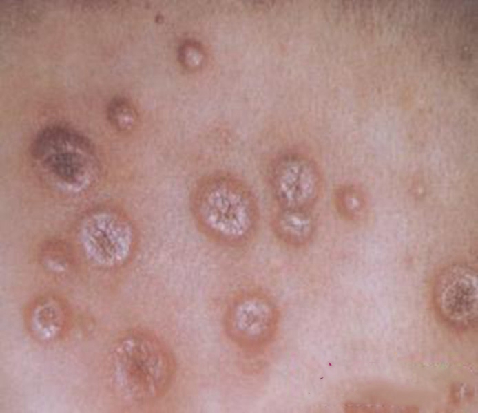 淋病梅毒 表面图片