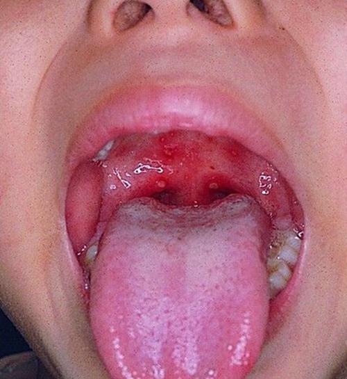 急性咽炎的症状的表现图片