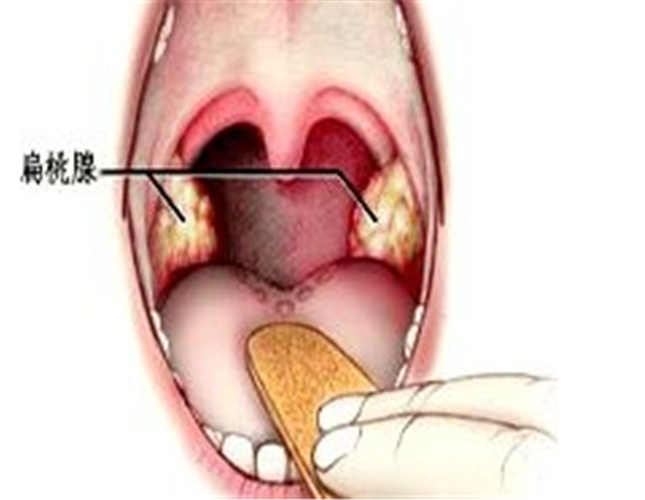 急性咽炎检查图片 (2)