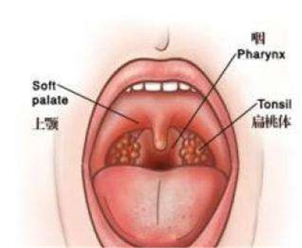 急性咽炎口腔图片