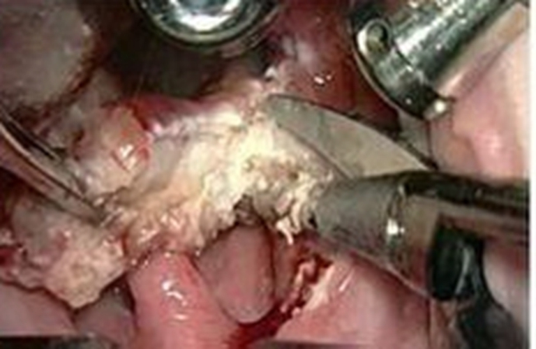 急性咽炎手术的图片