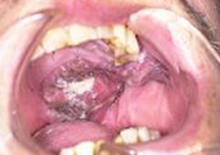 儿童口腔癌图片图片
