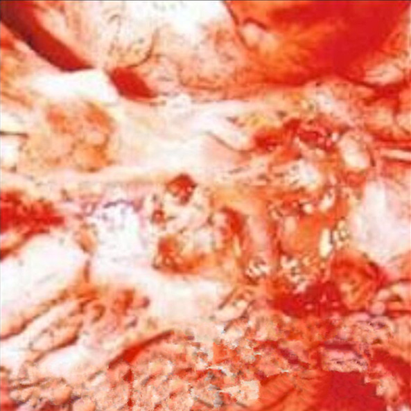 结核性脑膜炎的图片