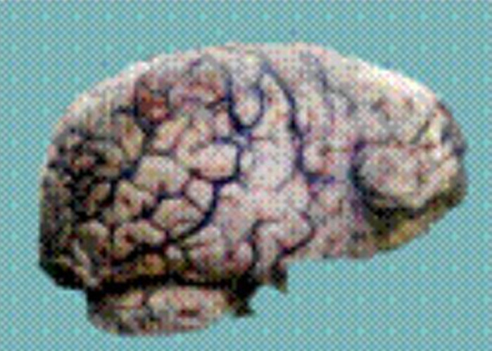 脑干脑膜炎结核性图片