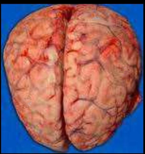 脑膜炎的解剖图片