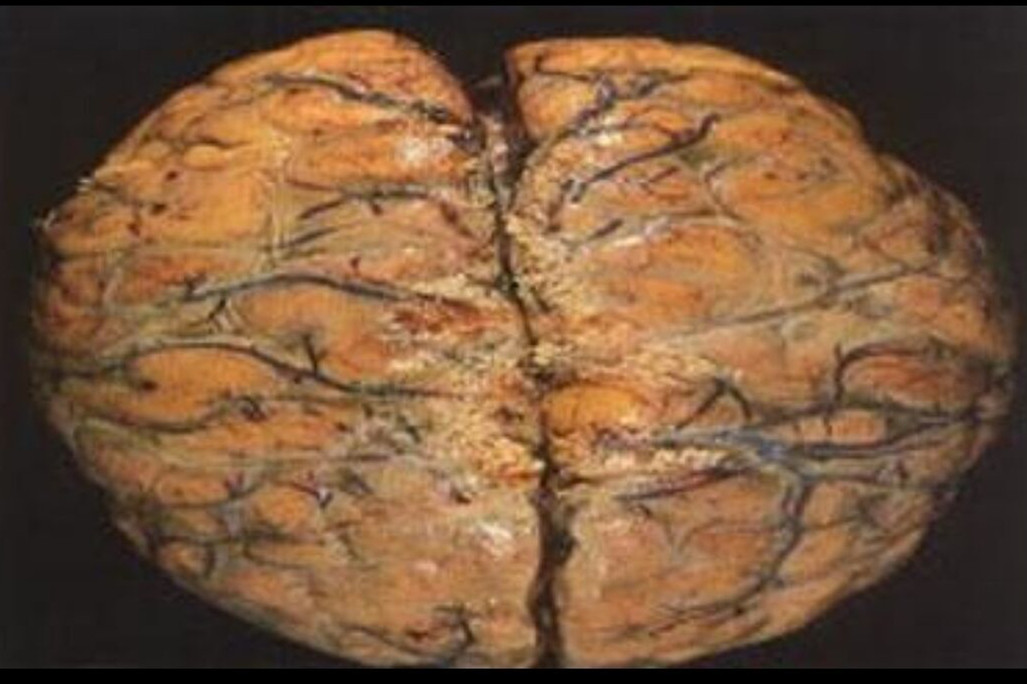 脑膜炎急性图片