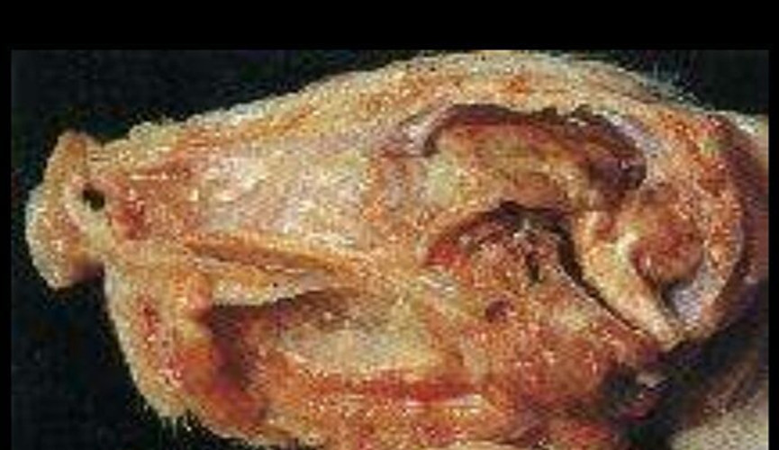 脑膜炎解剖图片