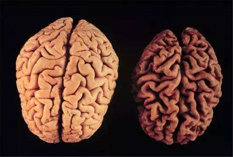 老年人脑萎缩大脑片对比图片