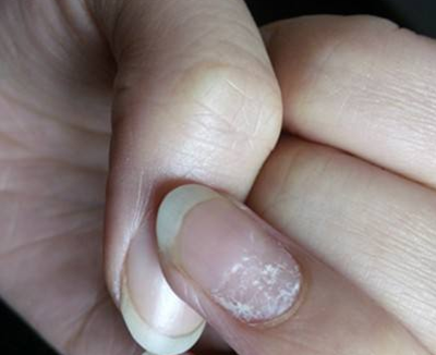 轻微灰指甲的症状图片图片