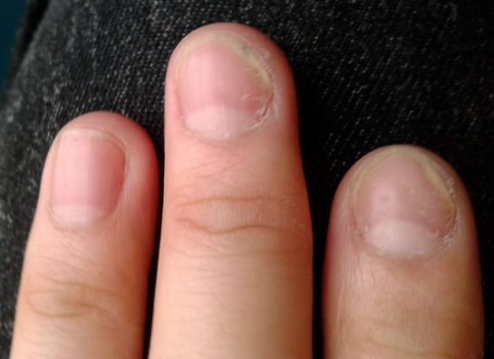 灰指甲初期症状图片图片