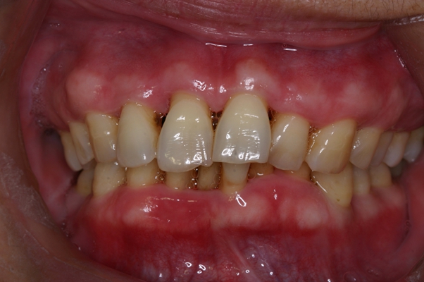 牙龈长骨刺的症状图片图片