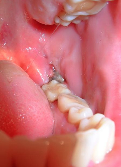口腔内牙槽骨增生图片图片