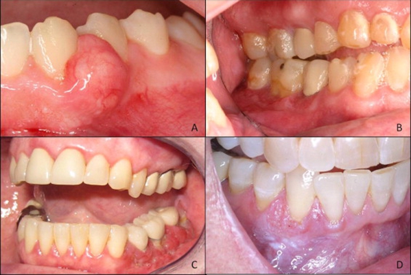 牙龈增生分叶状图片图片
